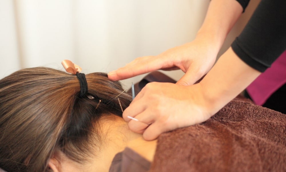 狛江の接骨院の肩こりへの鍼治療